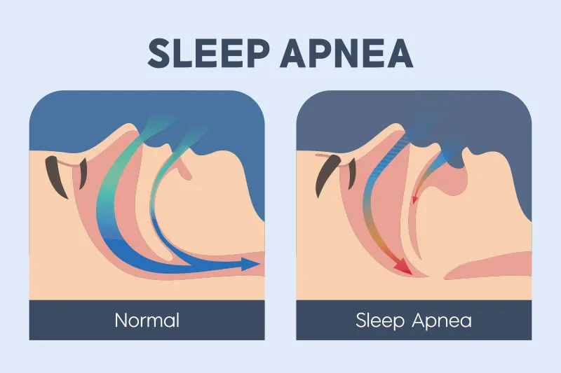 sleep apnea graphic